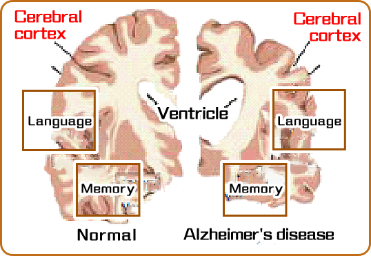 The picture shows atrophy of various parts of the brain in patients with Alzheimer's disease, including the cerebral cortex, ventricle, language area and memory area