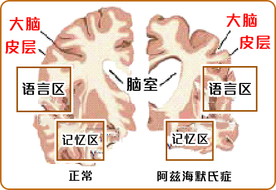 图片显示阿滋海默氏症患者的脑部各部位出现萎缩，包括大脑皮层，脑室，语言区以及记忆区