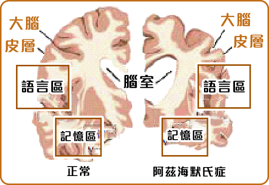 圖片顯示阿滋海默氏症患者的腦部各部位出現萎縮，包括大腦皮層、腦室、語言區以及記憶區